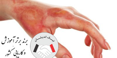 شستشو و پانسمان زخم سوختگی