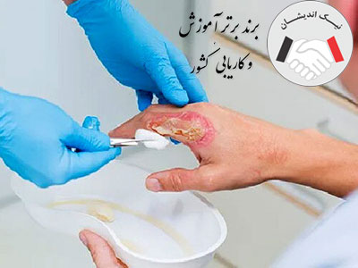 شستشو و پانسمان زخم سوختگی
