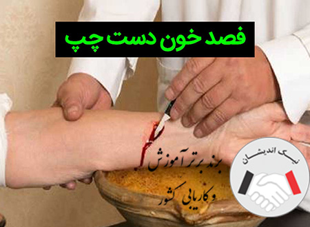 آشنایی با بهترین زمان فصد خون
